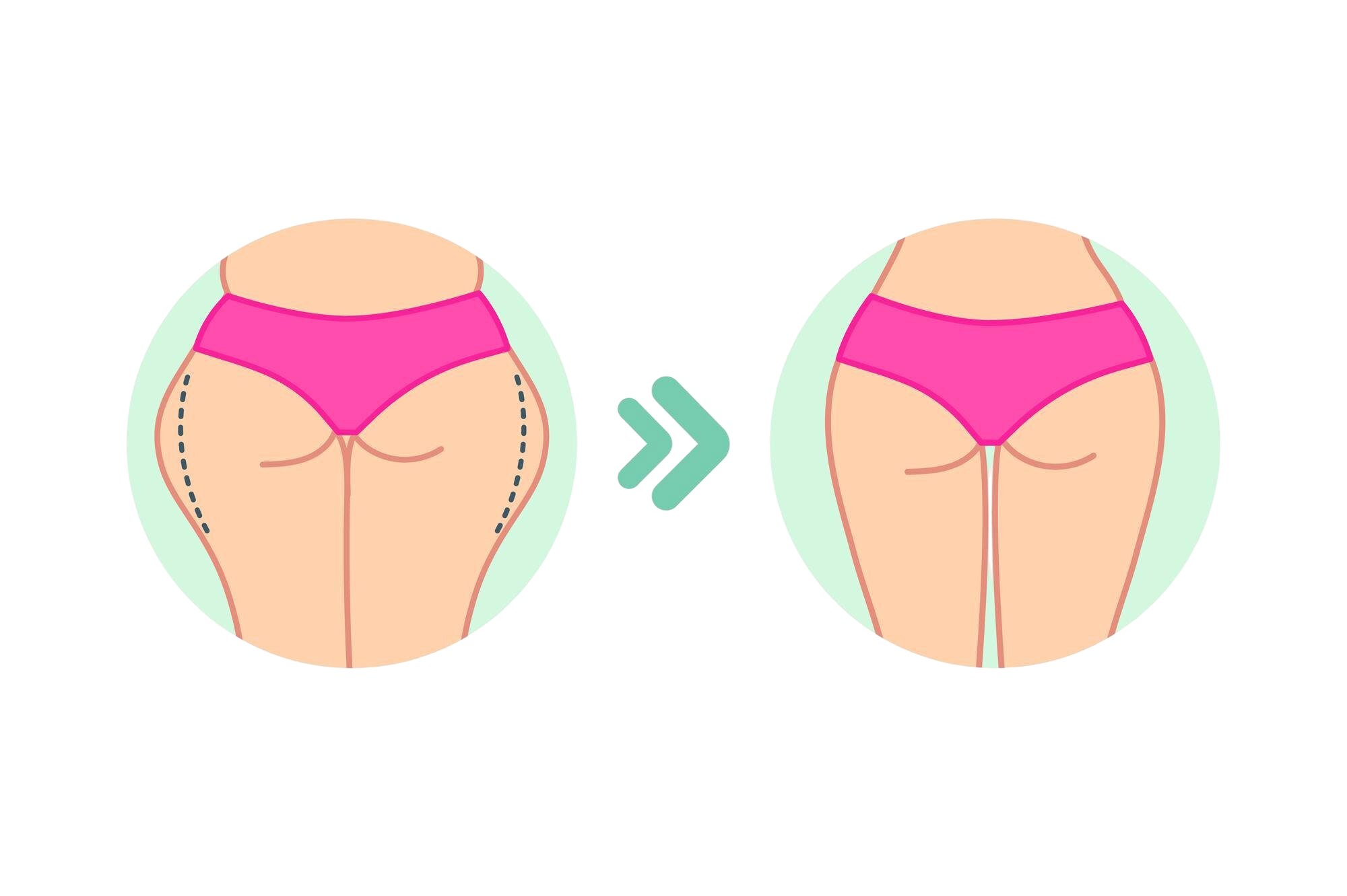 Illustration of before and after thigh fat reduction, showing slimmer and toned legs, liposuction surgery in nashik
