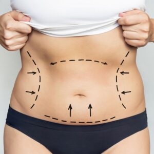 Laser Assisted Liposuction