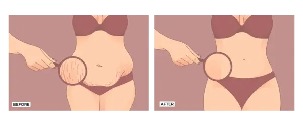 Before and after illustration of a woman’s abdomen showing stretch mark reduction and firmer skin.