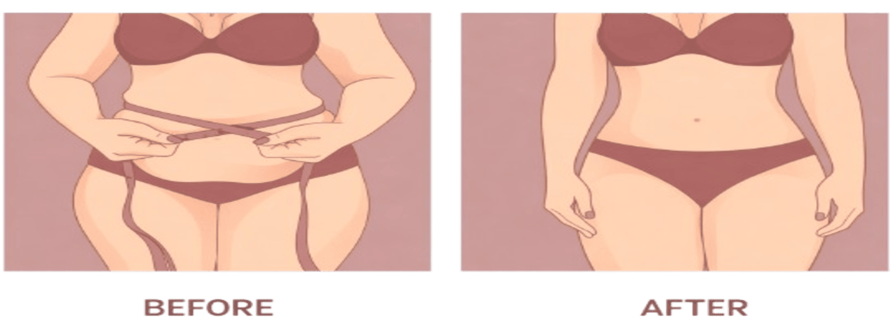 Before and after illustration of a woman’s abdomen showing stretch mark reduction and firmer skin.